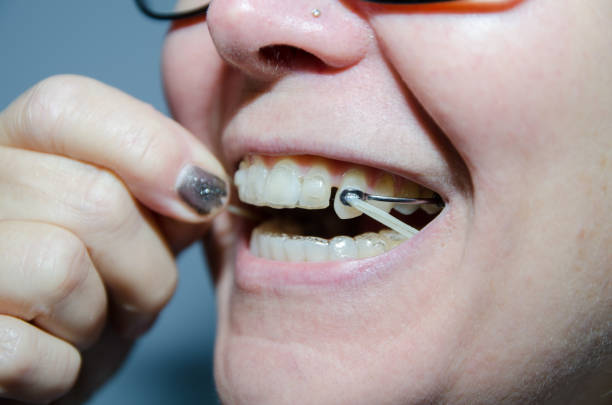 istock Close-up on woman removing elastic from dental braces 1446806865