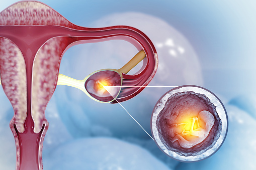 Ectopic Pregnancy. Fertilized egg attaches somewhere outside the uterus. 3d illustration