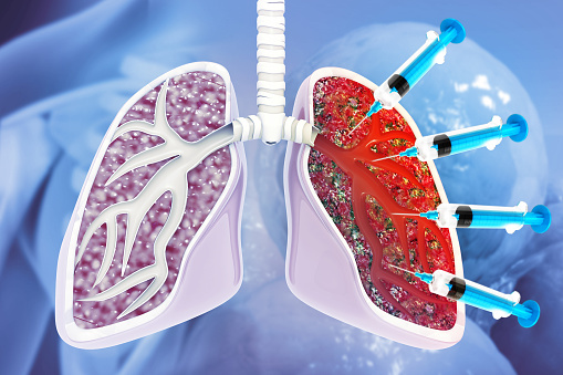 Interstitial Lung Disease, Causes, Diagnosis and Treatment, Injection, Drug Method Injection. 3d illustration