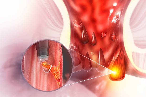 haemorrhoids (piles) on scientific background. surgery for bleeding haemorrhoids with external thrombosis. 3d illustration - hemorrhoid imagens e fotografias de stock