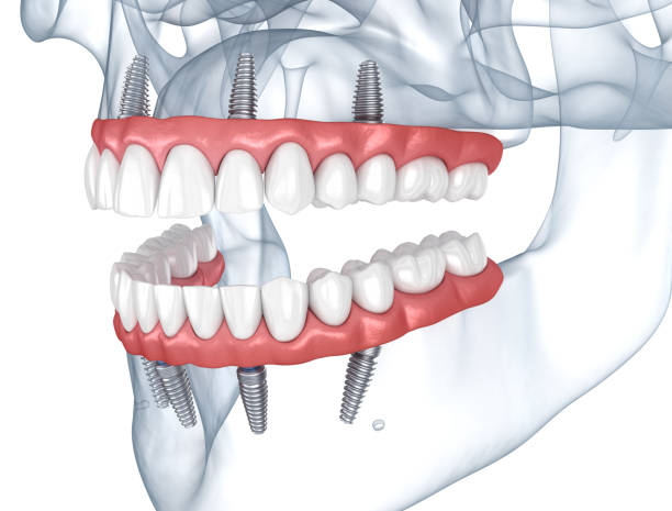 protesi supportate da 8 impianti. illustrazione 3d dentale - impianto dentale foto e immagini stock