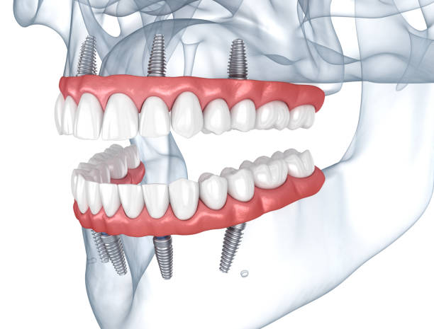 prostheses supported by 8 implants. dental 3d illustration - implantat imagens e fotografias de stock