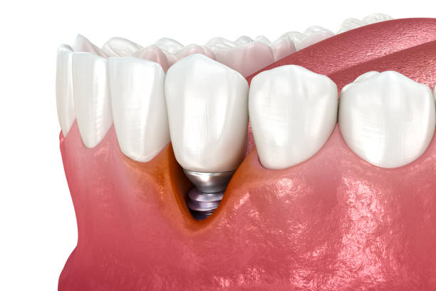 istock Peri-implantitis with visible gingiva recession. Medically accurate 3D illustration. 1446865167