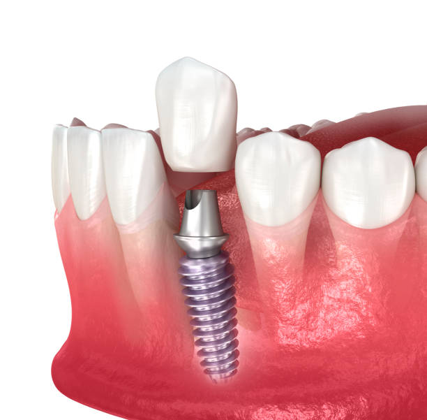 impianto dentale e corona in ceramica. illustrazione 3d dentale accurata dal punto di vista medico. - impianto dentale foto e immagini stock