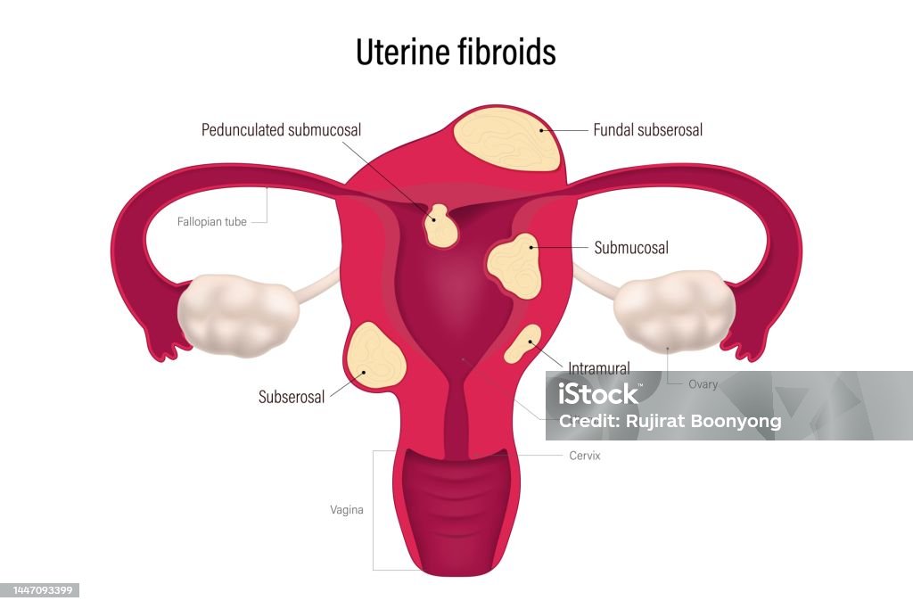 Uterine Fibroid Locations Pedunculated Submucosal Fundal Subserosal uterine-fibroid-locations-pedunculated-submucosal-fundal-subserosal