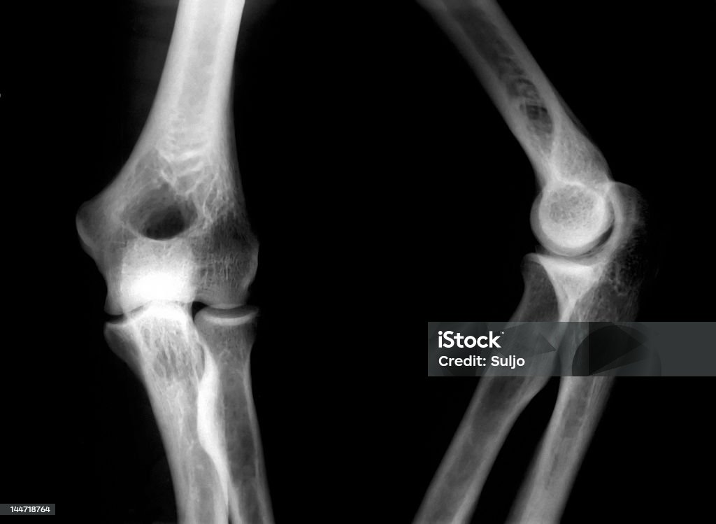 x-선 영상 무릎 - 로열티 프리 깨짐 스톡 사진