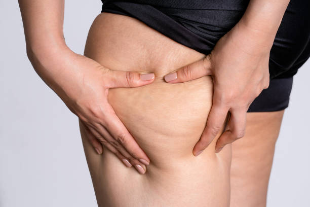 woman showing cellulite on legs like orange peel skin the concept of treatment and elimination of excess weight. - loose weight imagens e fotografias de stock