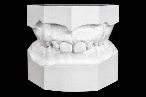 Plaster cast of a denture bite of a 13 year old person for medical examination