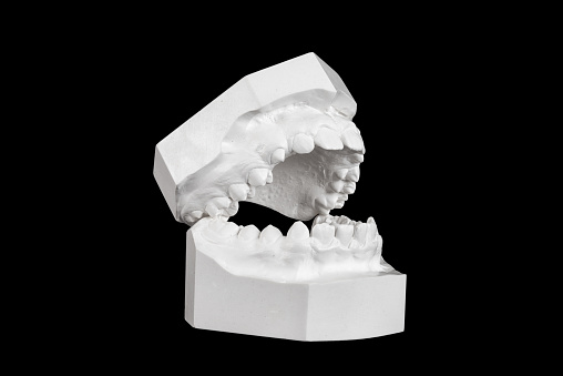 Plaster cast of a denture bite of a 13 year old person for medical examination