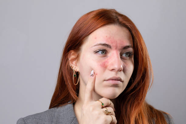 Fair skinned young woman suffering from rosacea. Facial redness due to couperose Young fair skinned Caucasian girl suffering from acne rosacea on face skin. Symptoms of couperose with redness of the cheeks and nose flushing stock pictures, royalty-free photos & images