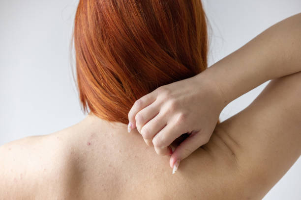 istock Back of a girl with dermatological problems and acne 1447448285