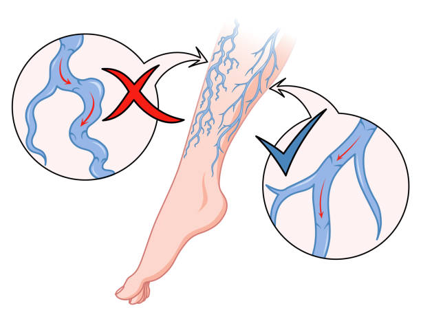 illustrations, cliparts, dessins animés et icônes de varices. vaisseau sanguin bleu visible à travers la peau, jambe anormalement enflée. diagnostic et traitement des maladies vasculaires. insuffisance veineuse appartement médical - venous insufficiency