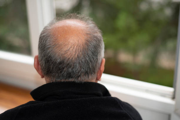 istock The back view of a man's head who is balding 1447899360