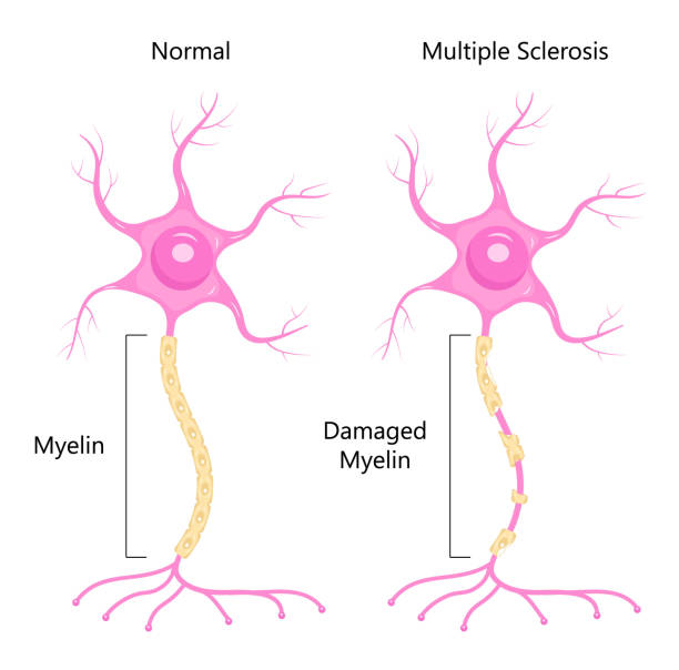 illustrazioni stock, clip art, cartoni animati e icone di tendenza di vettore concetto neuronale. dendrite, assone, soma di neurone. sclerosi multipla, illustrazione di anatomia nervosa. - axon