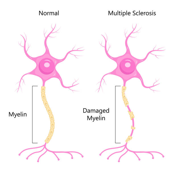 Neuron concept vector. Dendrite, axon, soma of neuron. Multiple sclerosis, nerve anatomy illustration. Neuron concept vector. Dendrite, axon, soma of neuron. Multiple sclerosis, nerve anatomy illustration. Myelin and nucleus of brain cell. neural axon stock illustrations