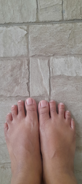 Sunburned feet after wearing sandals. Left and right foot with sunburn marks.