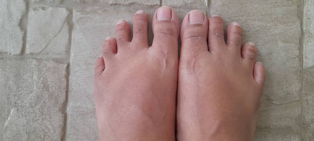 Sunburned feet after wearing sandals. Left and right foot with sunburn marks.