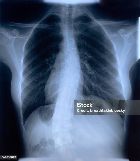 Photo libre de droit de Intéressant Xray Du Film De Femme De La Poitrine banque d'images et plus d'images libres de droit de Adulte - Adulte, Anatomie, Articulation du corps humain