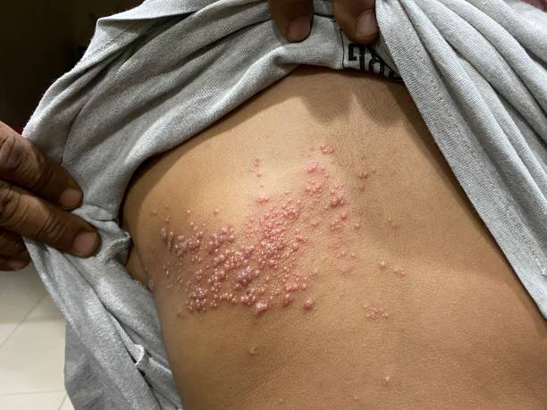 Shingles Shingles is a viral infection caused by varicella-zoster virus. It mainly presented as a painfull blister rash anywhere on the body shingles rash stock pictures, royalty-free photos & images
