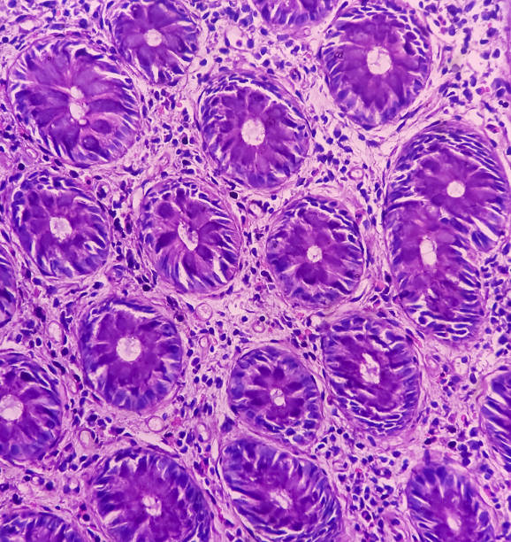 istock Transverse colon microscopic image seen atypical cell, colonic mucosa, infiltration of inflammatory cells. 1448296264