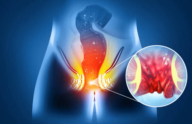 istock Haemorrhoids (piles) on scientific background. 3d illustration 1448517586