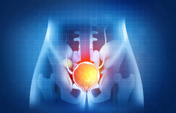 prostate disease, benign prostatic hyperplasia (bph), prostate cancer. 3d illustration - urinblåsa bildbanksfoton och bilder