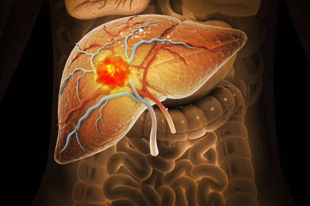 Liver cancer, Hepatocellular Carcinoma (HCC), conditions, causes and treatment. 3d illustration stock photo
