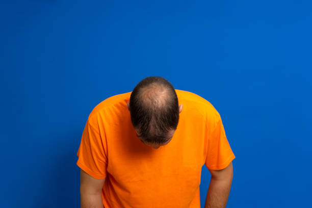 man in an orange t-shirt leaning his head forward to reveal his bald spot, isolated on blue studio background. - completely bald imagens e fotografias de stock