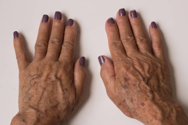 istock Hands with dark spots from age or sun exposure Melanosis. 1448588217