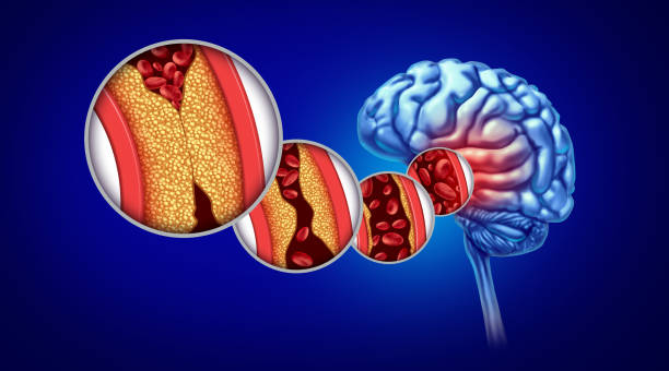 Stroke And Atherosclerosis Stroke and Atherosclerosis as a Brain disorder caused by blood cells blocked by fat and cholesterol build up as an artery blockage and hardening of the arteries causing a blockage of blood flow anatomy with 3D render elements. cerebrum stock pictures, royalty-free photos & images