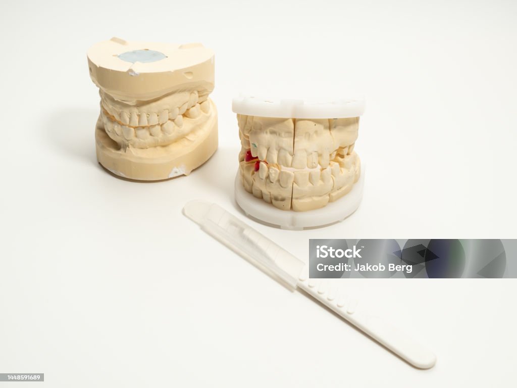 Cast For Tooth Dental Casts On A White Background Plaster Model Of Teeth Stock Photo ...