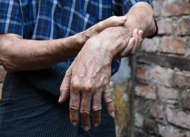 istock Radial nerve injury or wrist drop 1448736382