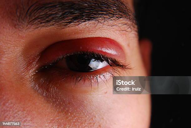 Augenoperation Stockfoto und mehr Bilder von Geschwollen - Geschwollen, Auge, Allergie