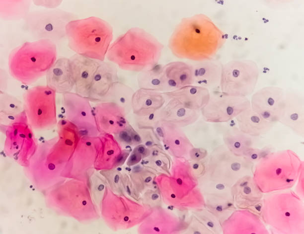 rozmaz paps pod mikroskopem pokazujący rozmaz zapalny ze zmianami związanymi z hpv. rak szyjki macicy. scc - cytologia zdjęcia i obrazy z banku zdjęć