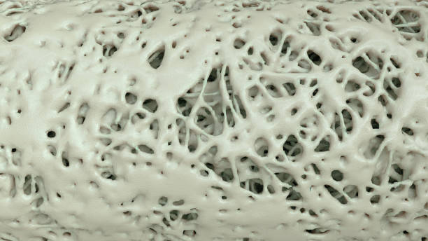 istock Cross section of an advanced osteoporosis - 3d rendering 1449027716
