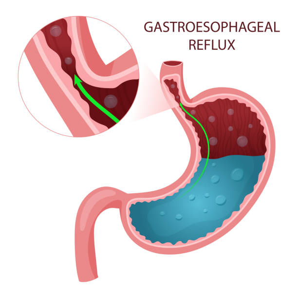 istock Gastroesophageal reflux disease diagram. Detailed illustration. 1449080130