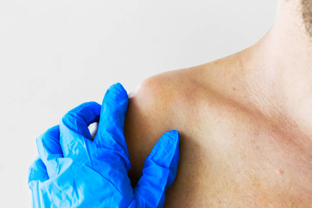 dislocation or fracture of the clavicle and acromial process with displacement. the doctor examines the patient with a dislocation and fracture of the clavicle and acromial process, close-up - clavicle imagens e fotografias de stock