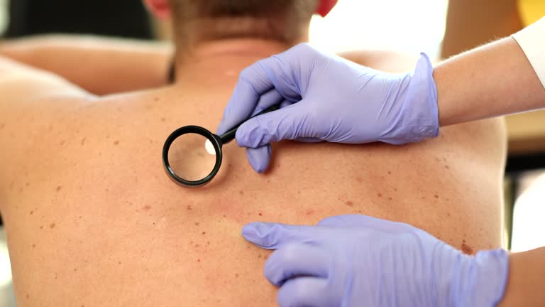 Oncologist with magnifying glass in hand examines pigmented nevi on back of man