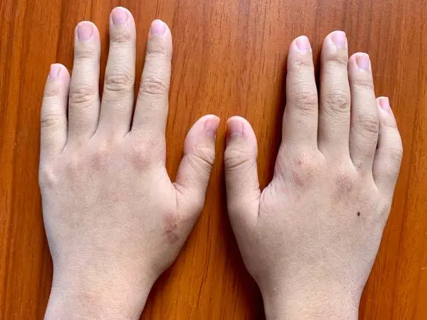 Cyanotic hands or peripheral cyanosis or blue hands at Southeast Asian, Chinese man