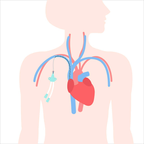 ilustraciones, imágenes clip art, dibujos animados e iconos de stock de diagrama médico del catéter venoso de la vía central tunelizada - surgery catheter cardiac catheterization hospital