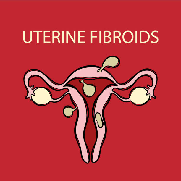 UTERINE FIBROIDS Female Reproductive Medicine Education UTERINE FIBROIDS Leiomyoma Benign Tumor Of The Smooth Muscles Of The Uterus Painful Or Severe Menstruation Medical Education Banner Vector Illustration Scheme diagram of female reproductive system drawings stock illustrations