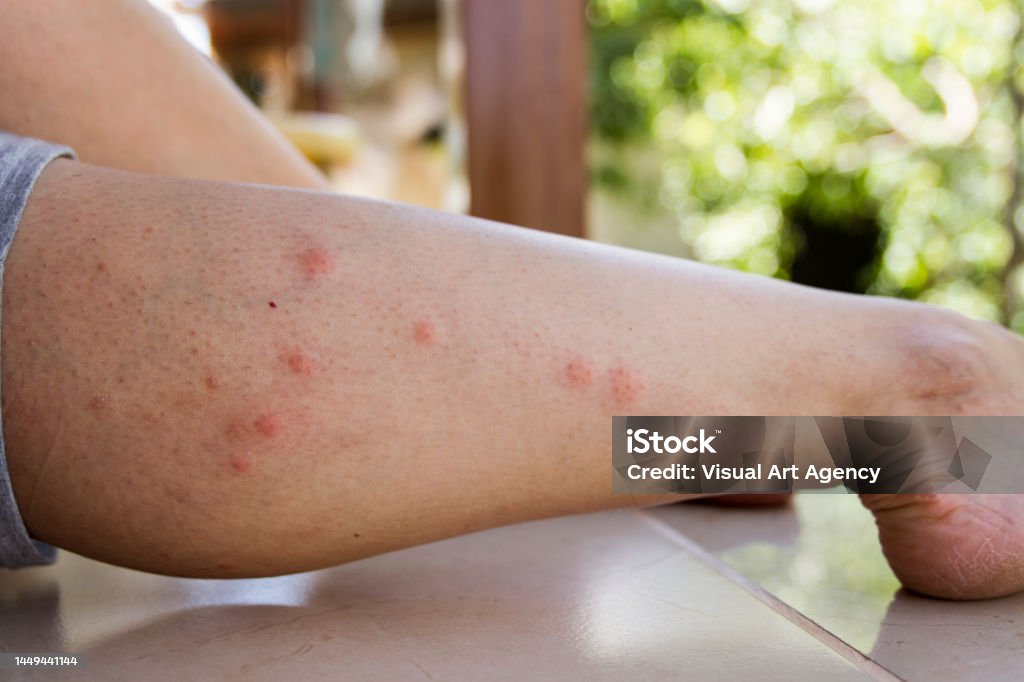 Mosquito Bites On Leg Mosquito Bite Stock Photo