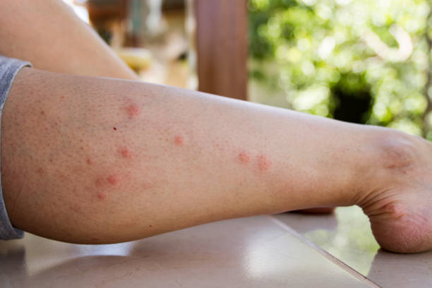 Mosquito Bites On Leg stock photo