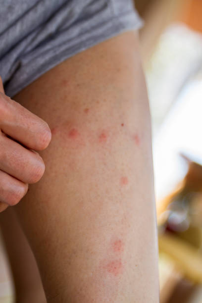 istock Woman Scratching Mosquito Bites 1449441327
