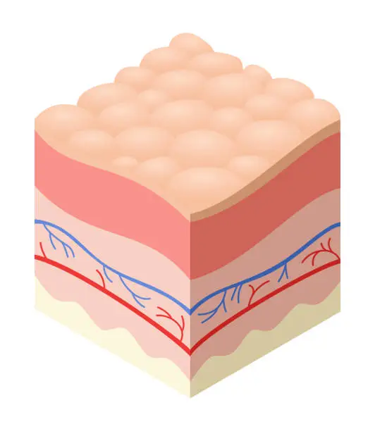 Vector illustration of Skincare medical concept. Problems in cross-section of human skin horizontal layers structure. Anatomy illustrative model unhealthly layer of skin