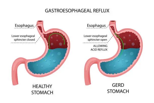 Vector illustration of Healthy stomach and GERD infographic