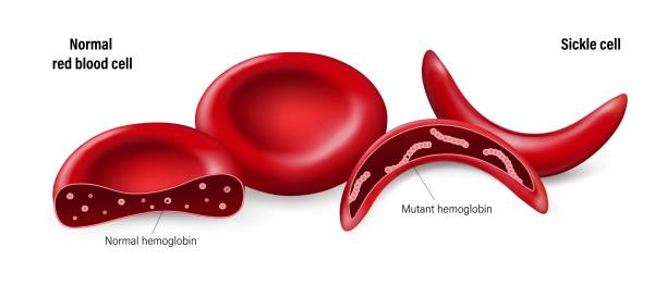 ilustraciones, imágenes clip art, dibujos animados e iconos de stock de enfermedad de células falciformes. glóbulos rojos normales y glóbulos rojos falciformes. hemoglobina normal y hemoglobina mutante. - sickle cell anemia red blood cell blood cell anemia