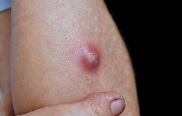 istock Large carbuncle or abscess at forearm 1449527392