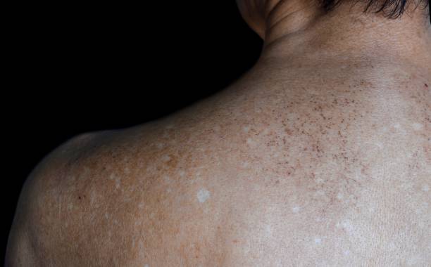 Age spots and white patches on upper back. They are brown, gray, or black spots and also called liver spots, senile lentigo, solar lentigines, or sun spots.