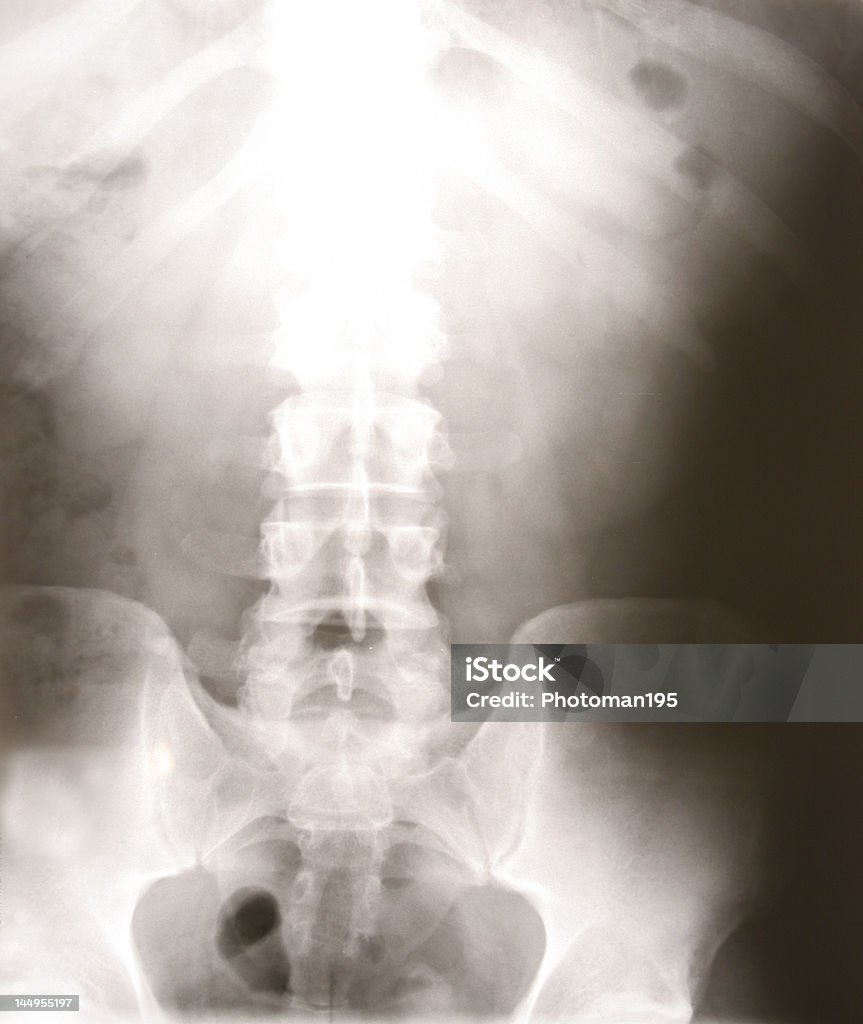 X-Ray de la poitrine et à la région lombaire, avec bassin - Photo de Accident bénin libre de droits